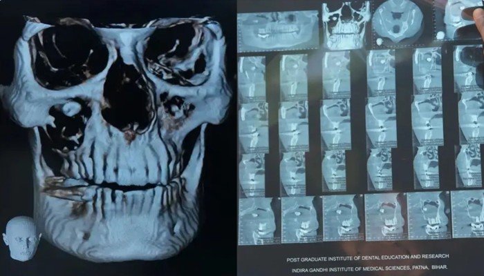বিরল অস্ত্রোপচারে চোখ থেকে দাঁত অপসারণ