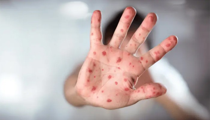 ​৭ জেলায় বড় আকারে ছড়িয়েছে প্রাণঘাতী হাম