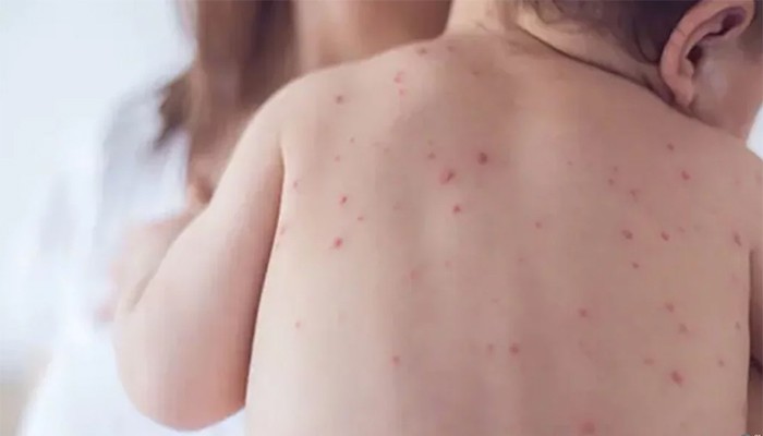 ​শিশুকে হাম থেকে বাঁচাতে যা করবেন