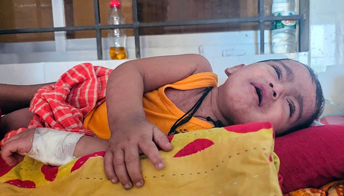 ​৫৬ জেলায় ছড়িয়ে পড়েছে হাম, উদ্বিগ্ন বিশ্ব স্বাস্থ্য সংস্থা