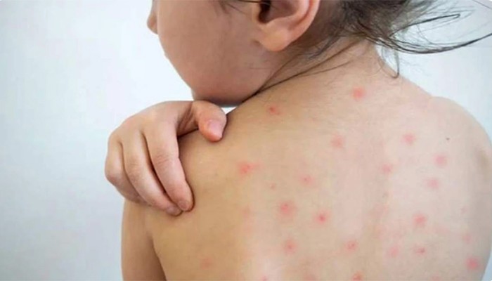 হাম ও উপসর্গে আরো ১১ মৃত্যু