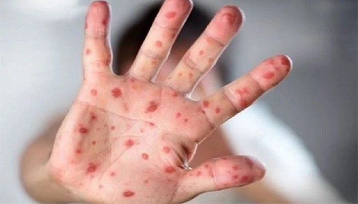 ​হাম ও হামের উপসর্গ নিয়ে আরও ১০ শিশুর মৃত্যু