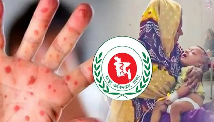 ​হাম ও উপসর্গে আরো ৯ মৃত্যু, বাড়ছে সংক্রমণ