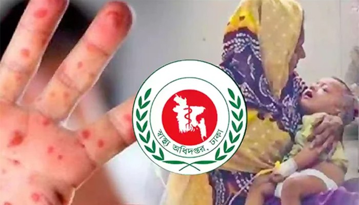 ​হাম উপসর্গে আরও তিন মৃত্যু